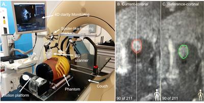 A phantom-based analysis for tracking intra-fraction pancreatic tumor motion by ultrasound imaging during radiation therapy